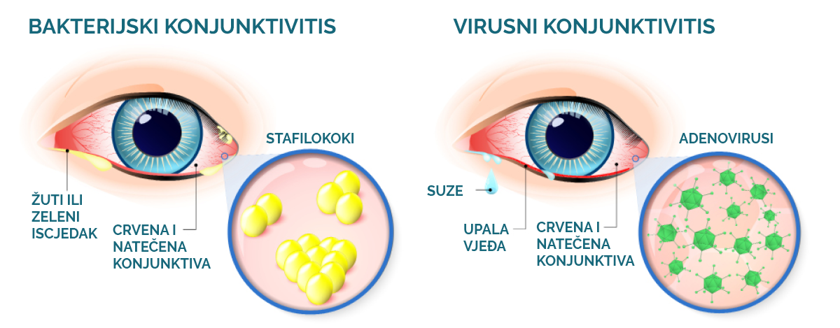 usporedba: virusni konjunktivitis i bakterijski konjunktivitis